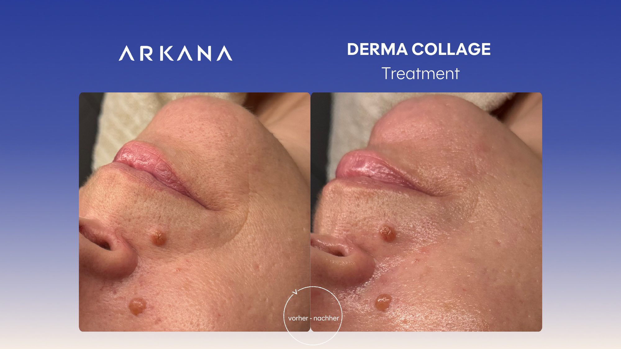 Vorher-Nachher Ergebnis: Derma CollAGE Treatment