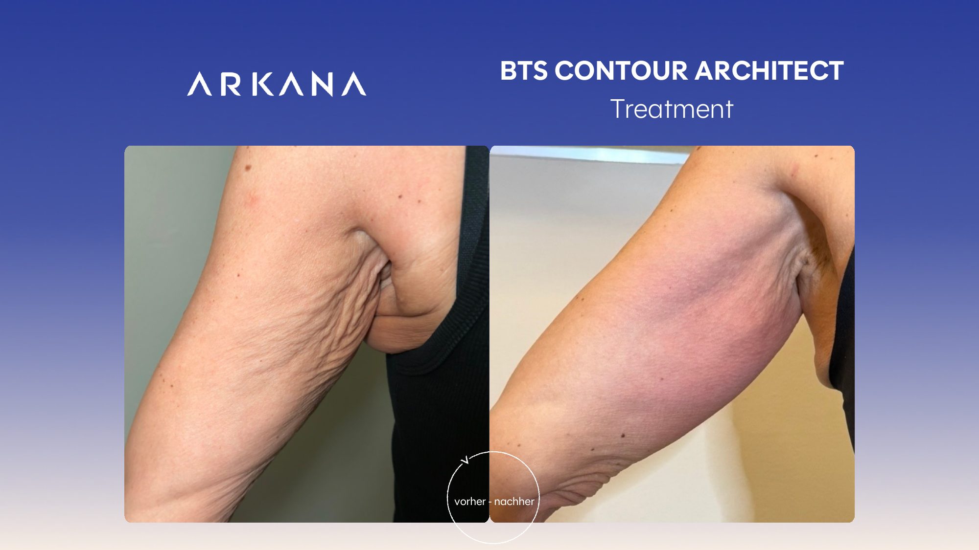 Vorher-Nachher Ergebnis: BTS Contour Architect Treatment