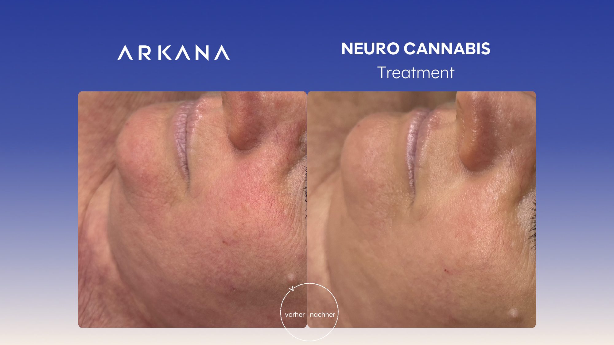 Vorher-Nachher Ergebnis: Neuro Cannabis Treatment