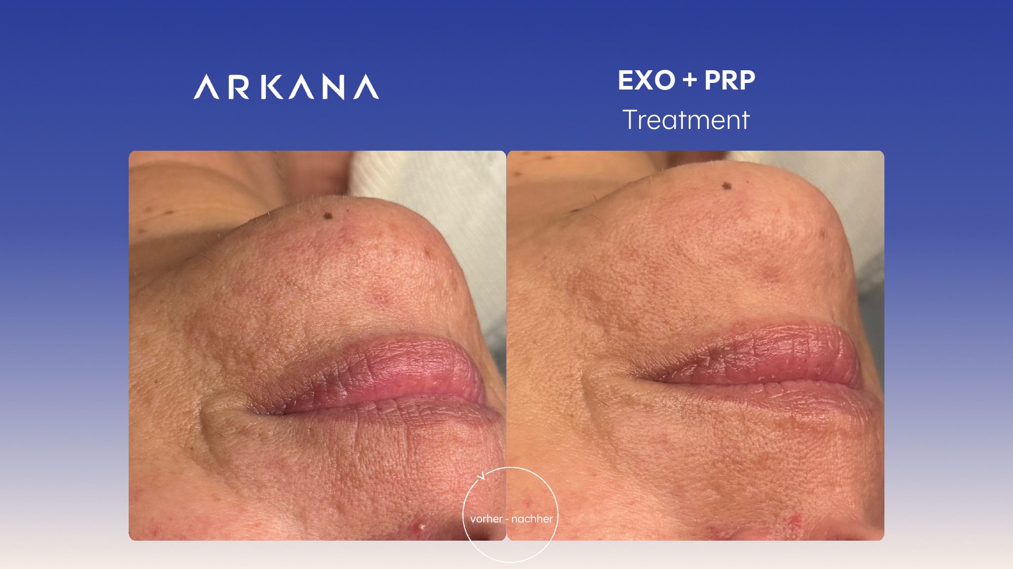 Vorher-Nachher Ergebnis: EXO + PRP Treatment